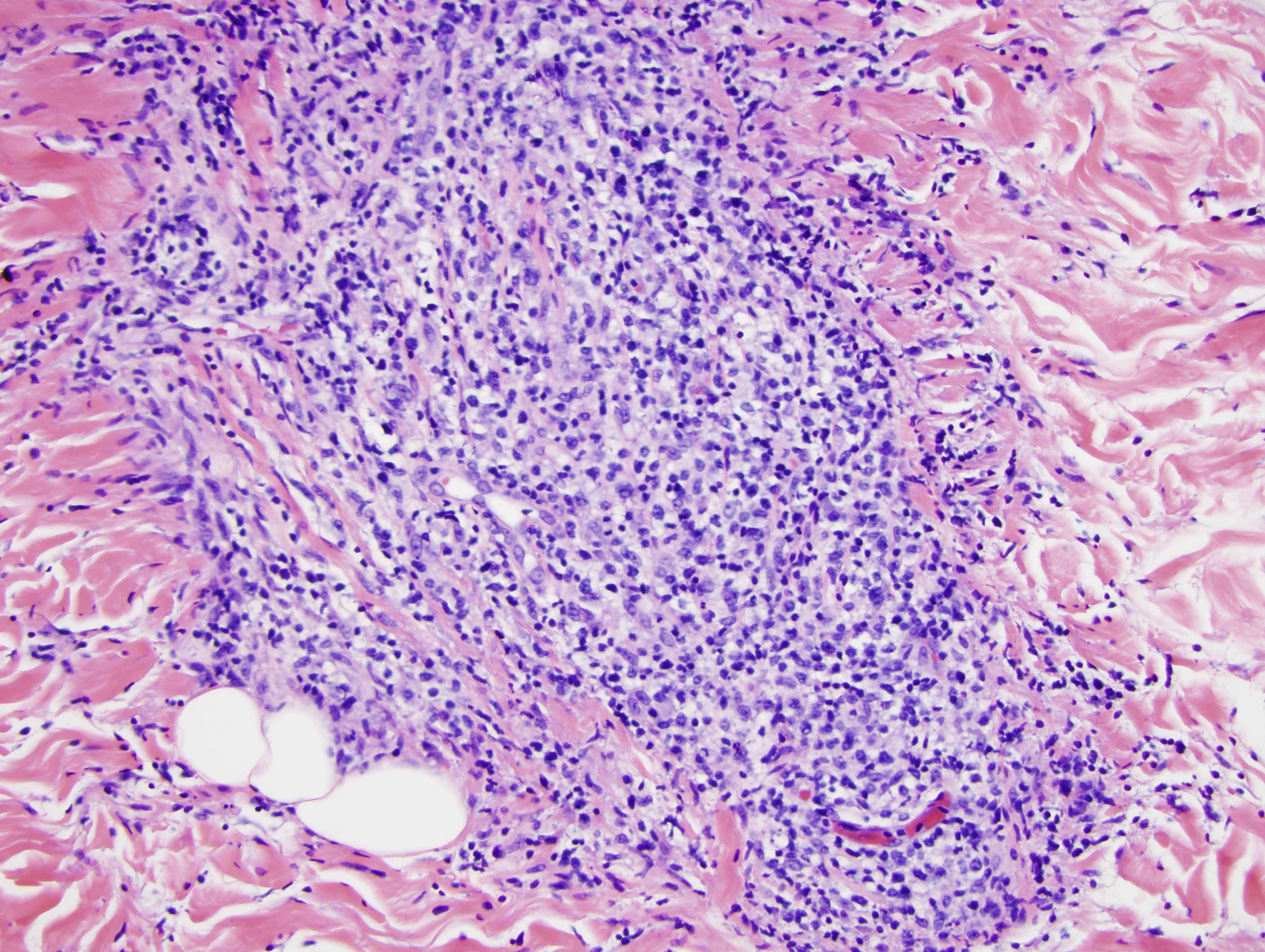 Slide 3: There is an extensive dermal infiltrate which assumes a very orderly arrangement around blood vessels, nerves and the eccrine coil.  There is some component of interstitial infiltration as well.  This infiltrate is very atypical and far exceeds the degree of intraepidermal lymphoid atypia recognizing that there is likely a histomorphologic spectrum of this abnormal lymphoid process ranging from the smaller lymphocytes that prevail in the epidermis to the larger ones found in the dermis.  Within the dermis there are many lymphocytes that are in the 15-20 micron size range.