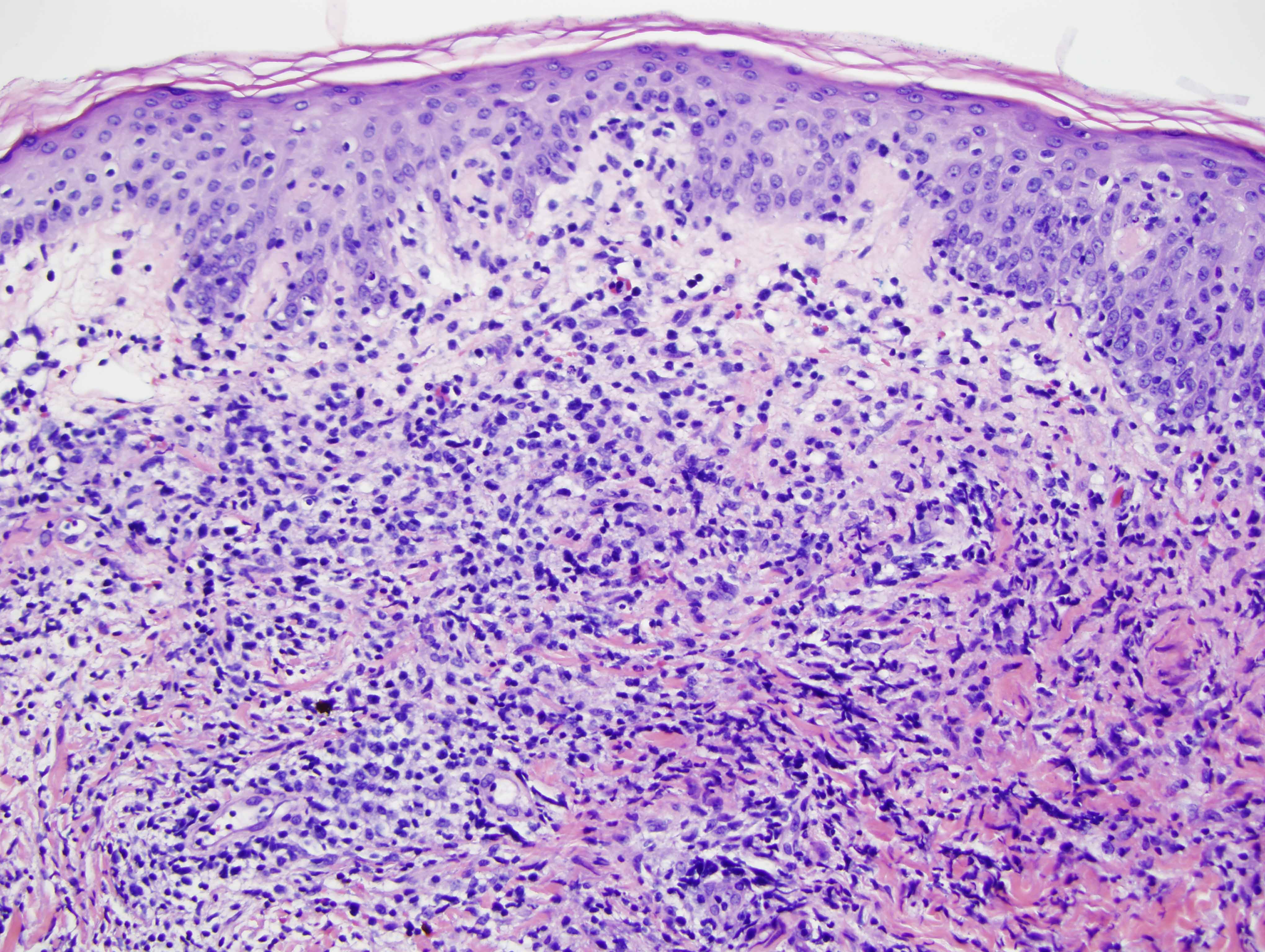 Slide 2: There is a component of interface change whereby lymphocytes are present along the dermal-epidermal junction with concomitant vacuous alteration of the basal layer keratinocytes with attendant epidermal attenuation alternating with zones of psoriasiform hyperplasia accompanied by slight hyperkeratosis.  The papillary dermis is somewhat edematous.  The lymphocytes that are permeative of the epidermis to define this vacuous interface process are small to intermediate in size showing rounded to somewhat angulated nuclear contours with nuclear hyperchromasia.