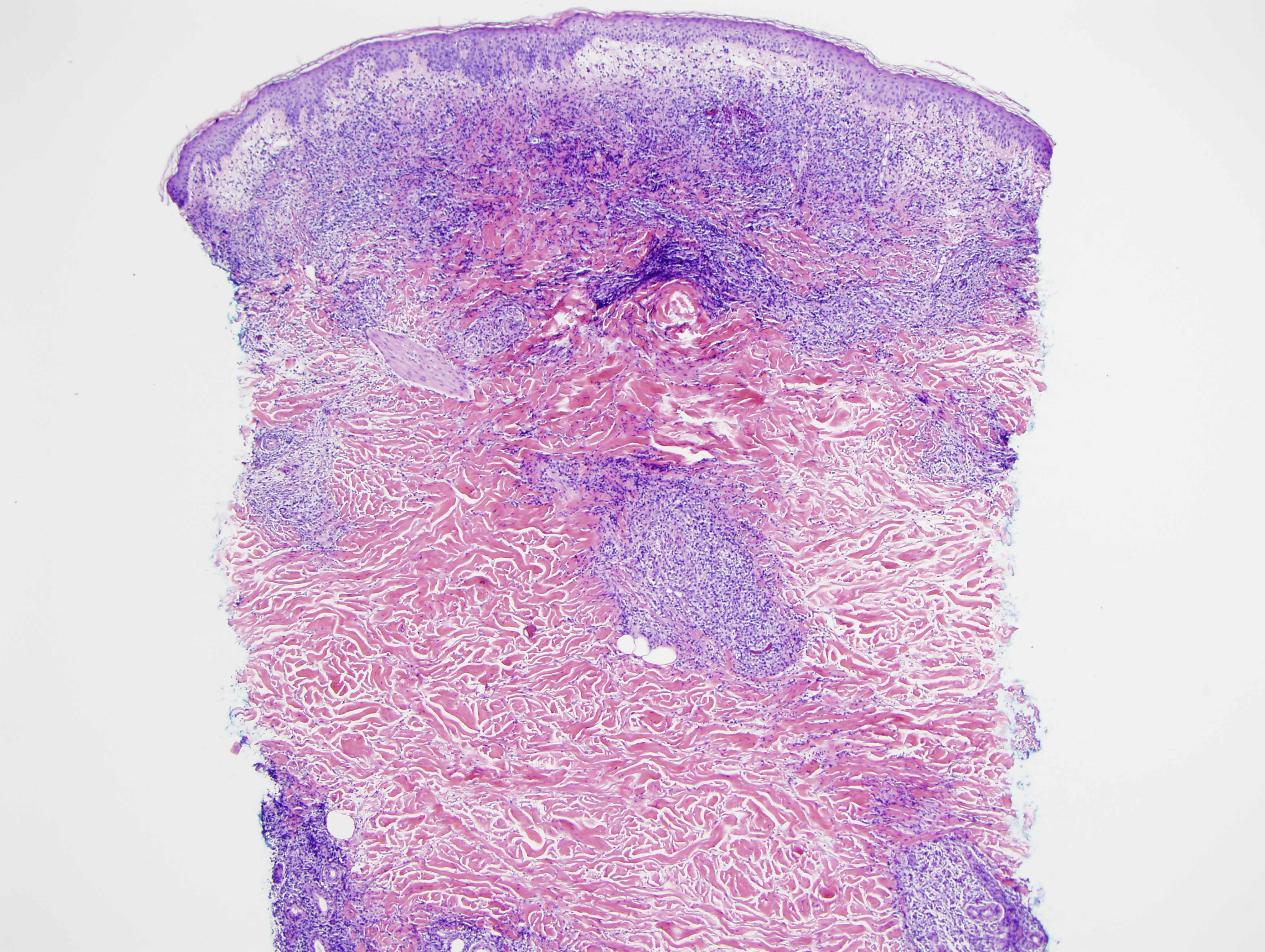 Slide 1: At low power, one can appreciate the atypical, extensive lymphocytic infiltrate.
