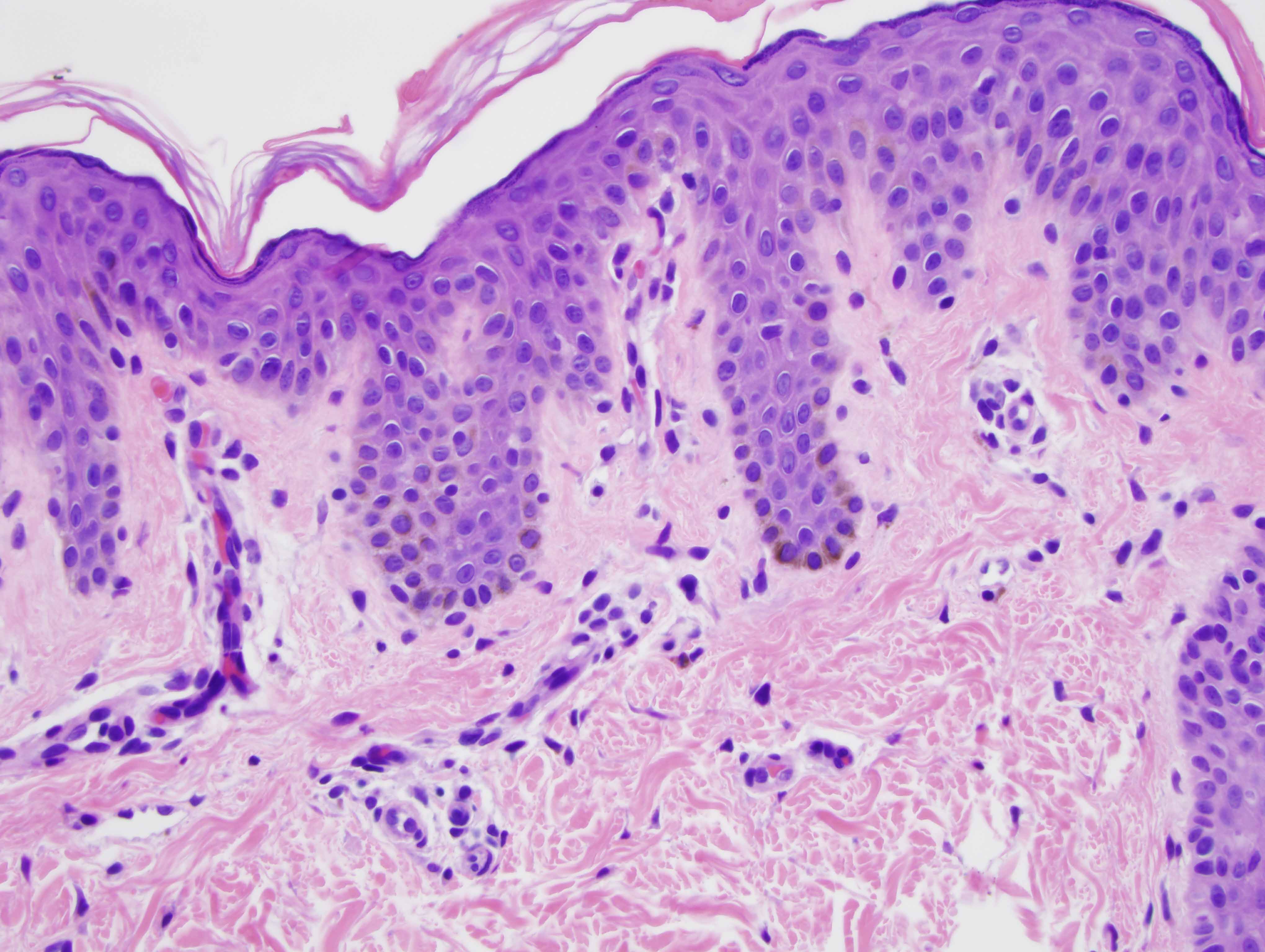 Slide 2: There are areas which show a mildly acanthotic epidermis associated with rete ridge elongation. There is basilar hypermelanosis.