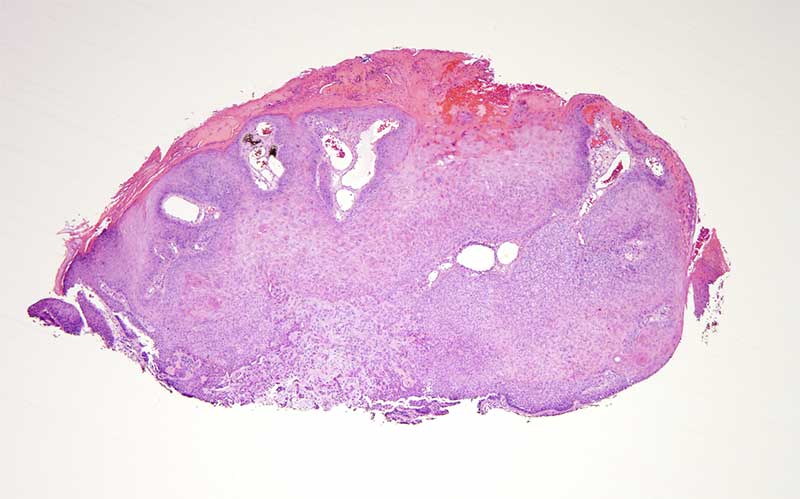 Slide 1: 32 year-old man with a right nostril mass.  Scanning magnification discloses a verrucous and endophytic squamous proliferation with an overlying hemorrhagic scale.