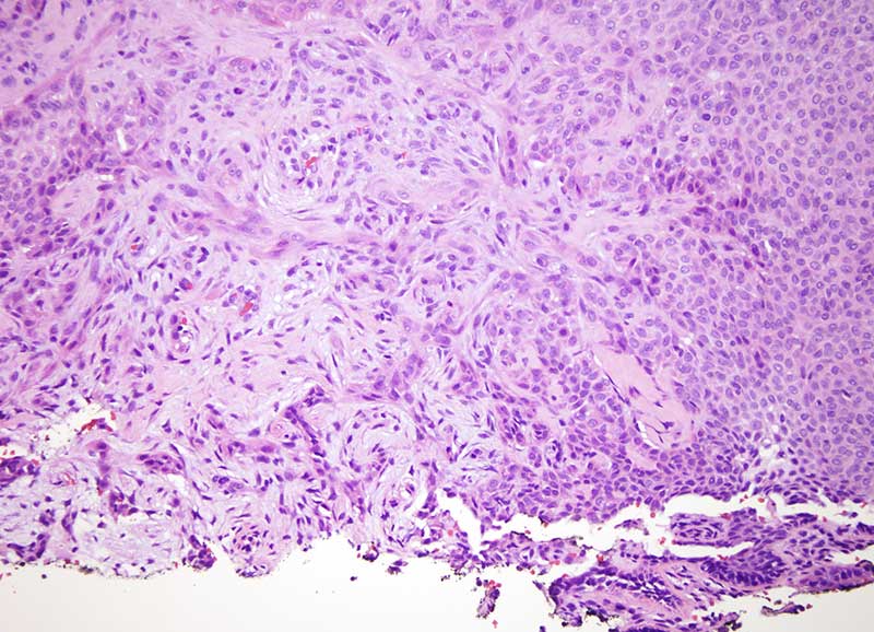 Slide 3: In this area the lesion assumes an infiltrative growth pattern with narrow cords of squamous epithelial cells amidst a mucinous fibrotic stroma.