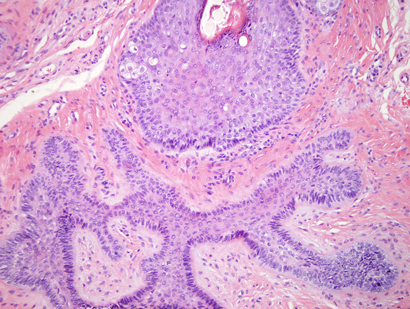 Slide 2: The biopsy is centered around a hair follicle.  There is expansion of the adventitial dermis by collagen. As well, the outer root sheath epithelium assumes a hyperplastic interanastomosing growth pattern with some component of germinative basaloid proliferation.  Overall, the lesion is most compatible with a fibrofolliculoma.