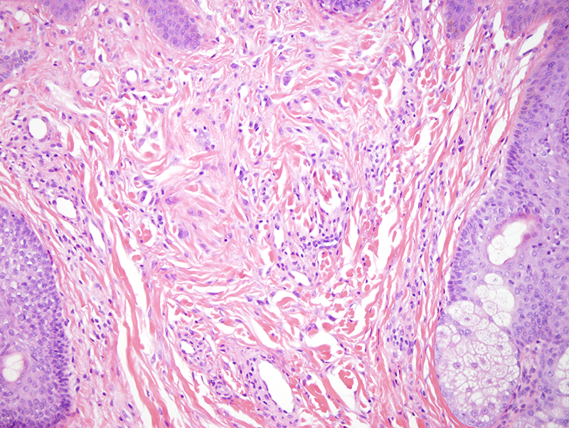 Slide 3: In addition, eosinophilic hyaline-like structures are found within the basaloid islands.  Overall, the cytomorphology and architecture of the lesion is reminiscent of a cylindroma.