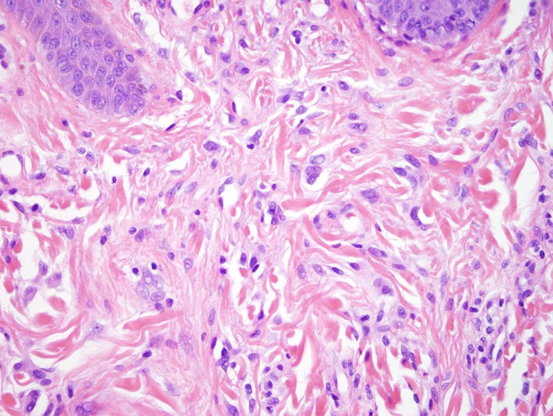 Slide 4: Coursing through the lesion are spindled and plump fibroblasts surrounded by thick collagen bundles. These are the features of an angiofibroma (fibrous papule).