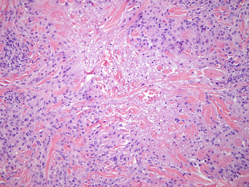 Slide 3: Within the necrobiotic areas there is deposition of fibrin and mucin.  The basic pattern is granuloma annulare. There is a background of lymphocytic infiltration surrounding vessels.