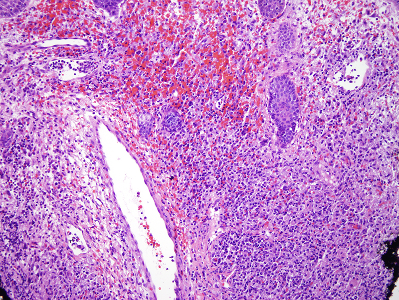 Slide 3: There is accentuation of the inflammatory cell infiltrate around blood vessels whereby this infiltrate is associated with concomitant vasculitic alterations which in turn range in quality from being more acute to chronic.  In particular, the vessels are surrounded and permeated by this aforesaid inflammatory cell infiltrate and show evidence of vascular compromise characterized by hemorrhage and hemosiderin deposition.