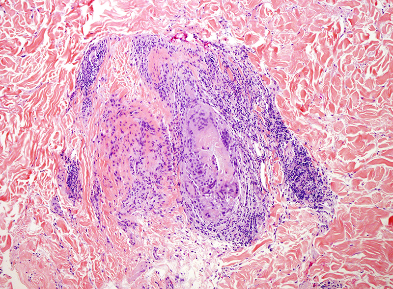 Slide 3: A deeper seated folliculocentric extension of the infiltrate is noted. A foreign body response to follicular derived keratin is noted.