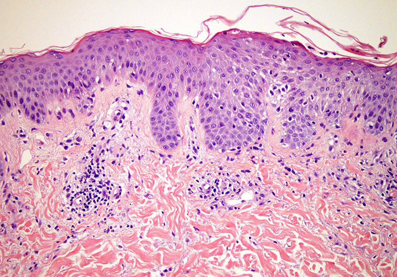 Slide 4: There is spongiosis with scattered necrotic keratinocytes and or streak dyskeratotic cells. A few Langerhans cell rich vesicles are noted. There is a mixed inflammatory cell infiltrate in the dermis which is both interstitial and angiocentric.