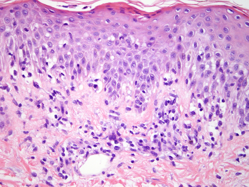 Slide 5: There is spongiosis with scattered necrotic keratinocytes and or streak dyskeratotic cells. There is a mixed inflammatory cell infiltrate in the dermis which is both interstitial and angiocentric. The lymphocytes are predominantly small without atypia.