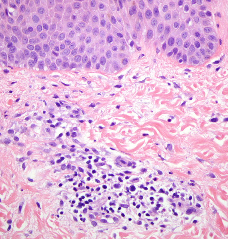 Slide 6: Another image of the superficial dermis which is highly remarkable for a striking pattern of neutrophilic dermolysis whereby seas of neutrophils are associated with disintegration of the connective tissue framework.