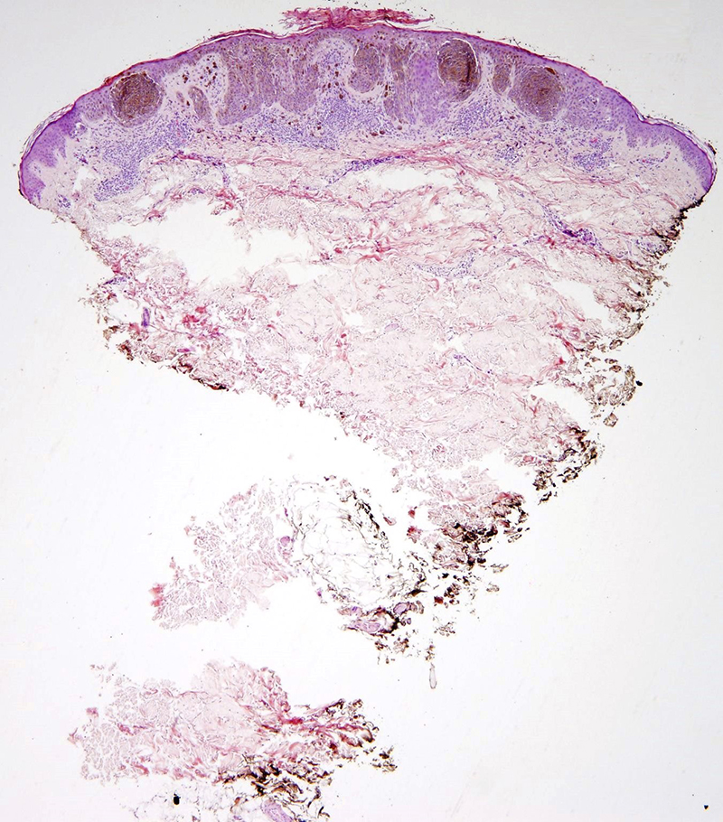 Slide 1: 44 year-old woman with a dark brown papule of the right arm.
