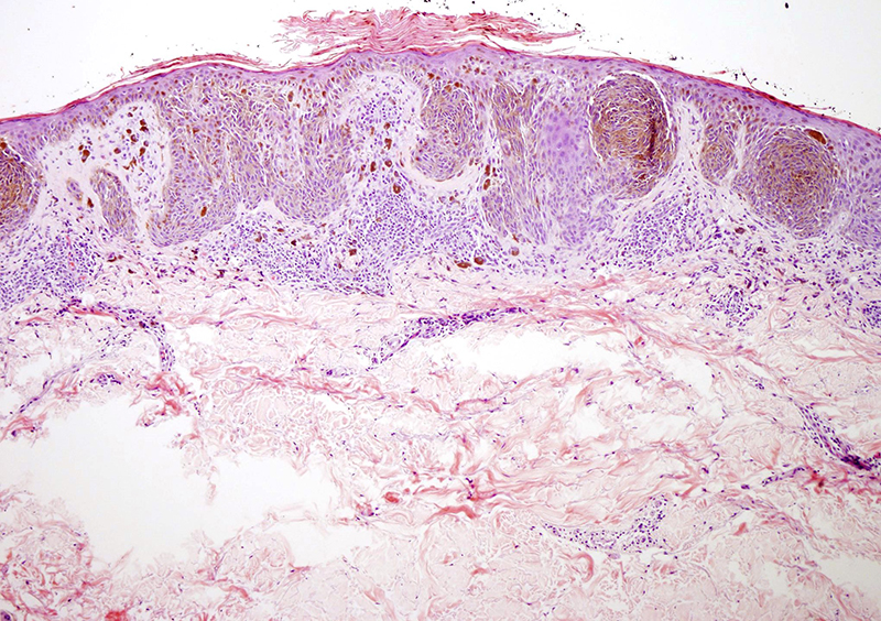 Slide 2: The excision specimen shows a very distinct circumscribed symmetrical lesion that spans a lateral breadth of roughly 2.0 mm.  The melanocytic lesion is composed predominantly of nests.