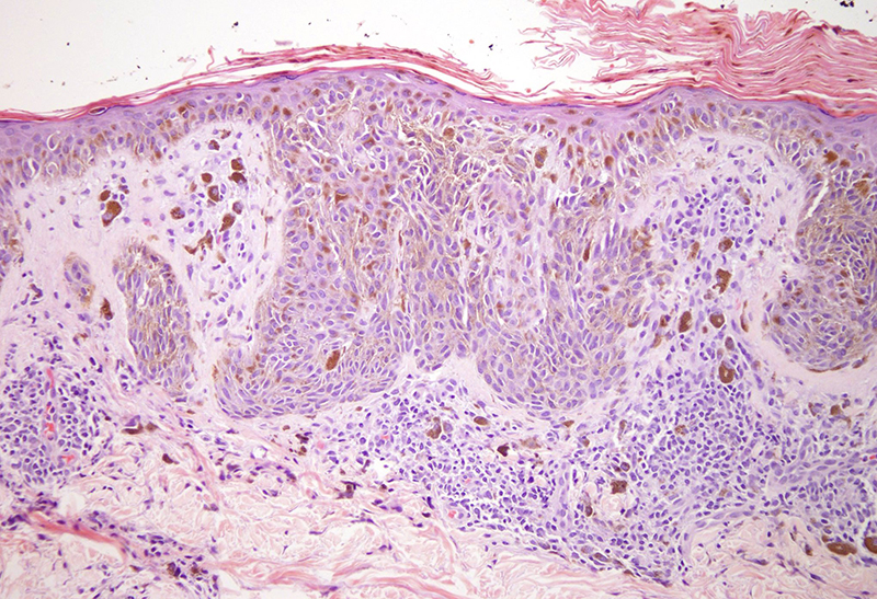 Slide 3: The nests follow the contours of the epidermis and focally assume a vertical orientation to the long axis of the epidermis with zones of retraction artifact from the epidermis although the nests themselves appear very cohesive.  The lateral borders of this lesion are characterized by circumscribed cohesive nests predominantly.  There is an attendant immunogenic host response.
