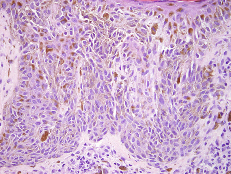 Slide 4: The nests have a very monotonous spindled appearance with cytoplastic melanization.  The diagnosis is Pigmented Spindle Cell Nevus of Reed.