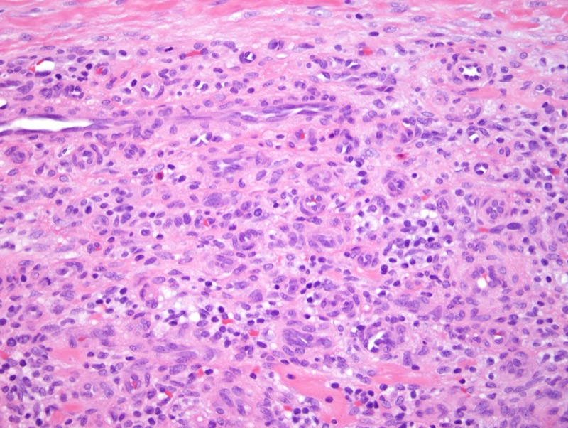Slide 5: In examining the endothelial cells that are hyperplastic and appear rather plump showing a hobnailed morphology with intracytoplasmic vacuoles exactly akin to what one encounters in an epithelioid hemangioma/angiolymphoid hyperplasia with eosinophilia.
