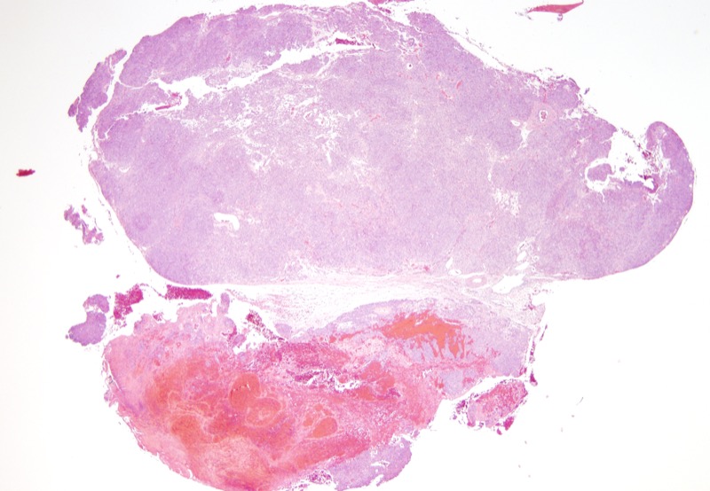 Slide 1: 54 year-old man with a soft tissue mass.<br><br>The biopsy shows a cellular multinodular tumor.