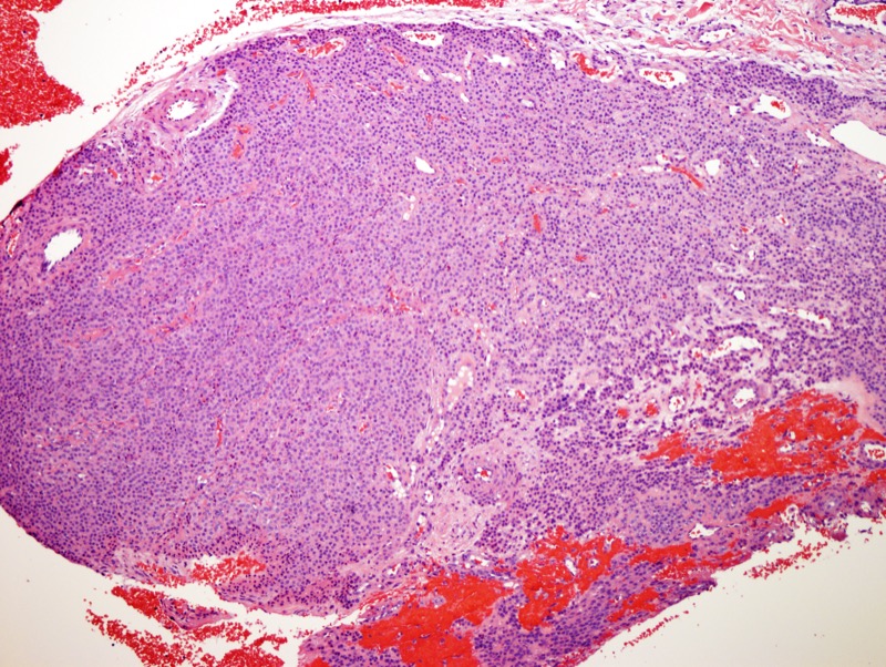 Slide 2: The tumor is composed of small cohesive nests of glomoid appearing cells.
