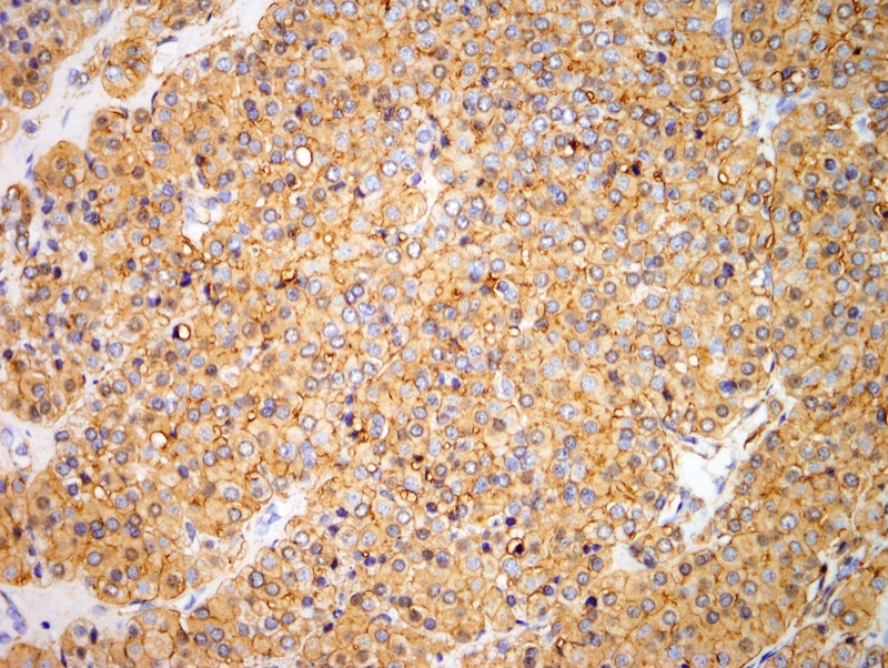 Slide 5: SMA immunostain is diffusely positive.