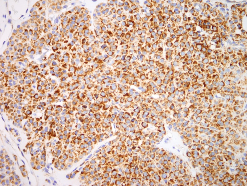 Slide 6: CD138 is also diffusely positive. There was extensive staining of the neoplastic cells for cytokeratin 5/6 and EMA (not shown).
