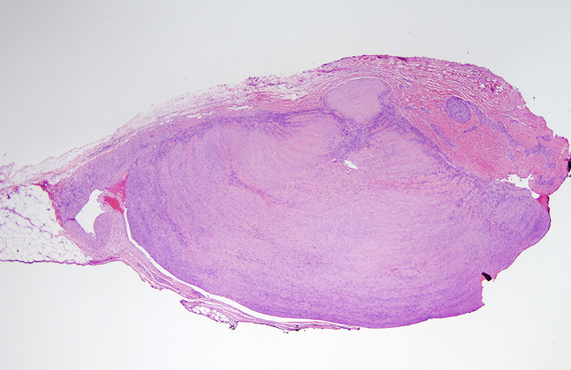 Slide 1: 30 year-old woman with a subcutaneous mass of the right thigh. The biopsy shows a multinodular tumor that is contiguous with a larger vessel indicative of its intravascular localization.