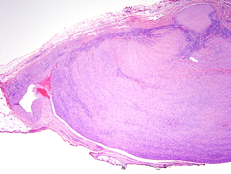 Slide 2: The biopsy shows a multinodular myomatous appearing tumor that is contiguous with a larger vessel indicative of its intravascular localization. The vessel within which this tumor exhibits a subendothelial localization appears to be a vein.