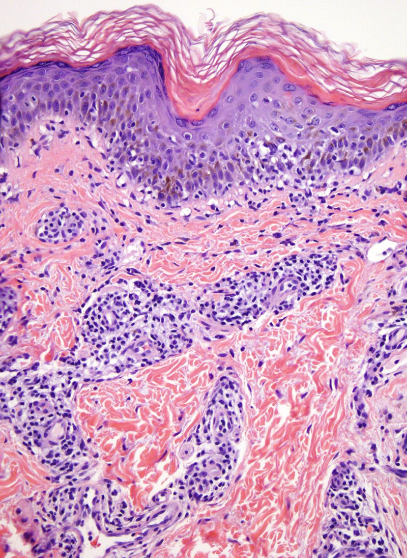 Slide 2: There is infiltration of the epidermis by lymphocytes.  As well there is an admixture of histiocytes. There is also a supervening angiocentric lymphohistiocytic infiltrate within the superficial corium.