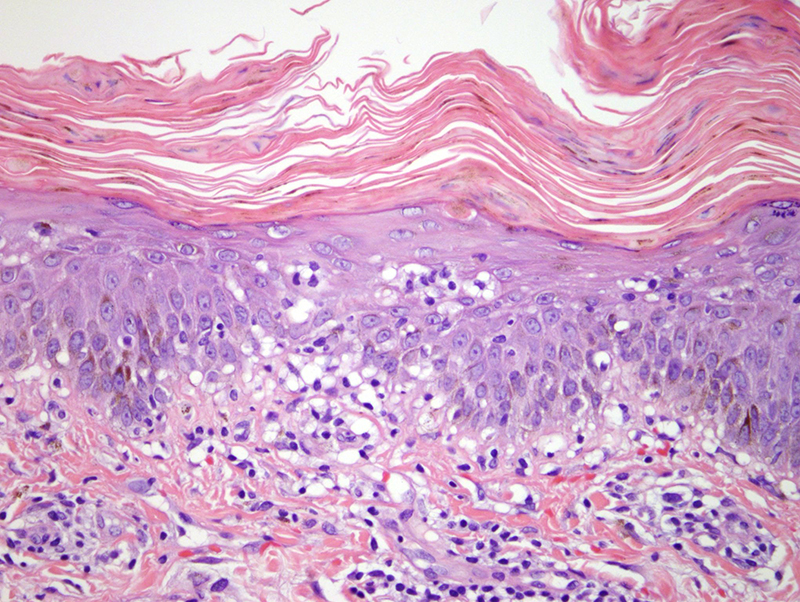Slide 3: There is infiltration of the epidermis by lymphocytes.  As well there is an admixture of histiocytes.  The lymphocytes exhibit a somewhat haphazard pattern of infiltration of the epidermis with a predilection to migrate towards the more superficial aspects of the epidermis whereby the lymphocytes are intimately admixed with histiocytic forms.