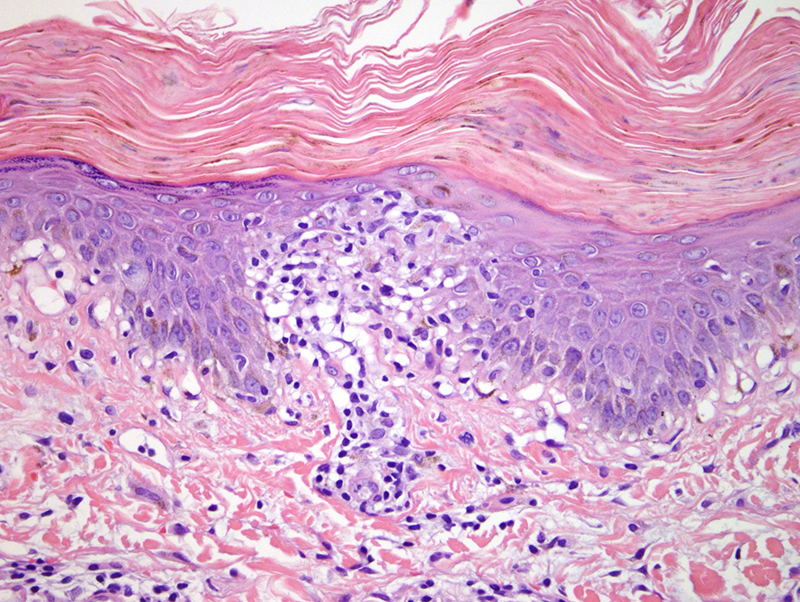 Slide 4: There is infiltration of the epidermis by lymphocytes.  As well there is an admixture of histiocytes.  The lymphocytes exhibit a somewhat haphazard pattern of infiltration of the epidermis with a predilection to migrate towards the more superficial aspects of the epidermis whereby the lymphocytes are intimately admixed with histiocytic forms.