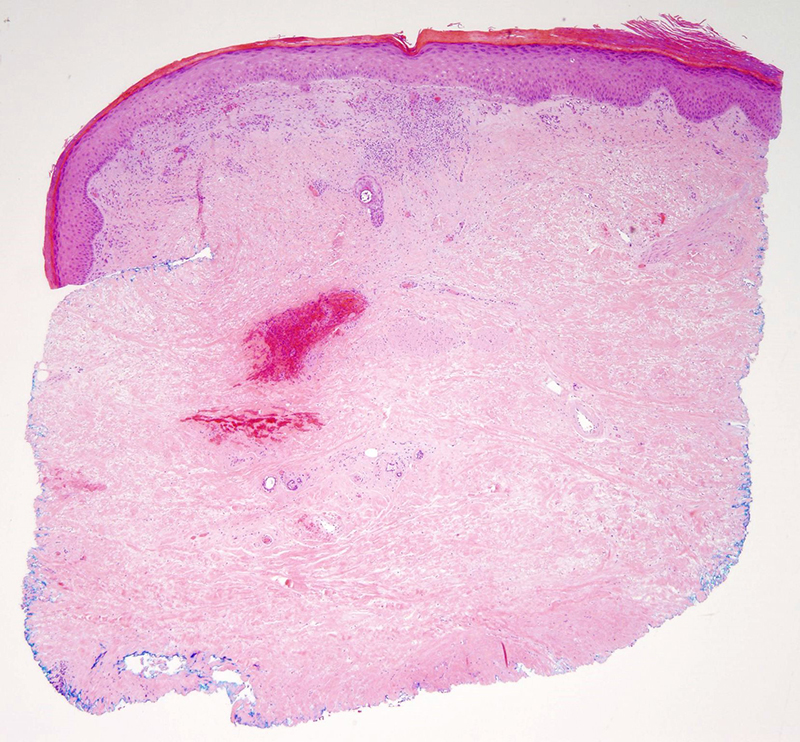 Slide 1: 70 year-old woman with bilateral lesions of the lower extremities.