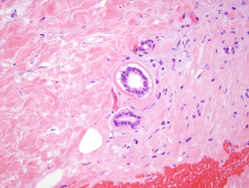 Slide 6: This sclerosing process is accompanied by a plasmacytic infiltrate.  The plasmacytic infiltrate is accentuated around blood vessels and relatively modest in degree albeit discernible.