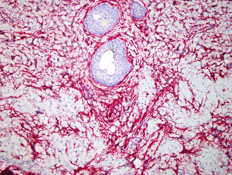 Slide 7: There is extensive staining of this spindled populace for CD34 while the S-100 (not shown) highlights a number of antigen presenting cells as well as shows positivity of the mature adipocytes. The Factor XIIIA preparation (not shown) was predominantly negative. The diagnosis is that of a fibroblastic connective tissue nevus as described by de Feraudy and Fletcher.