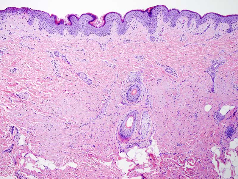 Slide 2: Within the mid and deep reticular dermis there is a proliferation of bland spindled cells with distinct tapered nuclei.