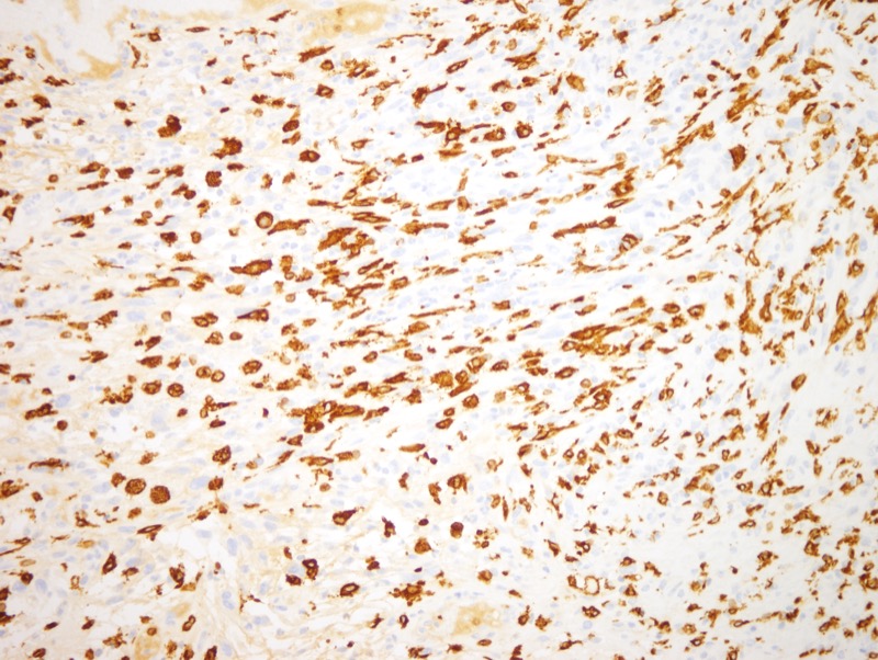 Slide 10: A number of the atypical cells are CD163 positive including the bizarre multinucleated tumor giant cells that are disposed throughout this malignant tumor.