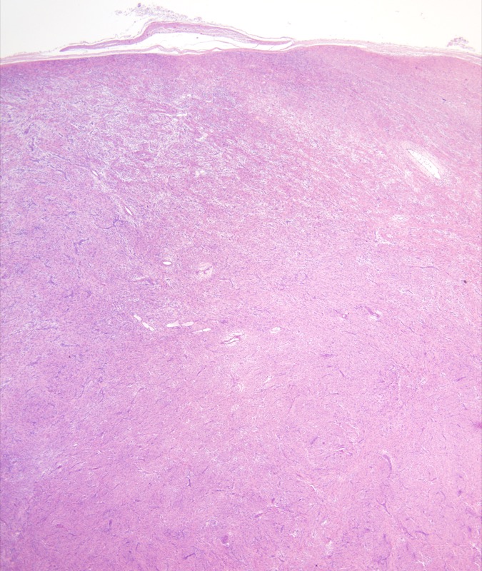 Slide 1: 80 year-old woman with a chest wall mass. The excision specimen consisted of a spindle cell lesion with a nodular configuration and variable cellularity.