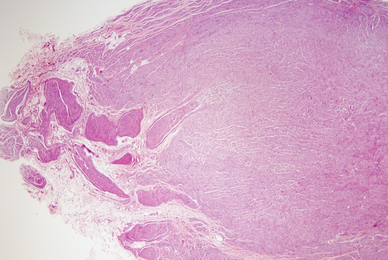 Slide 1: 55 year-old woman with breast carcinoma presenting for breast lumpectomy and sentinel node biopsy. 