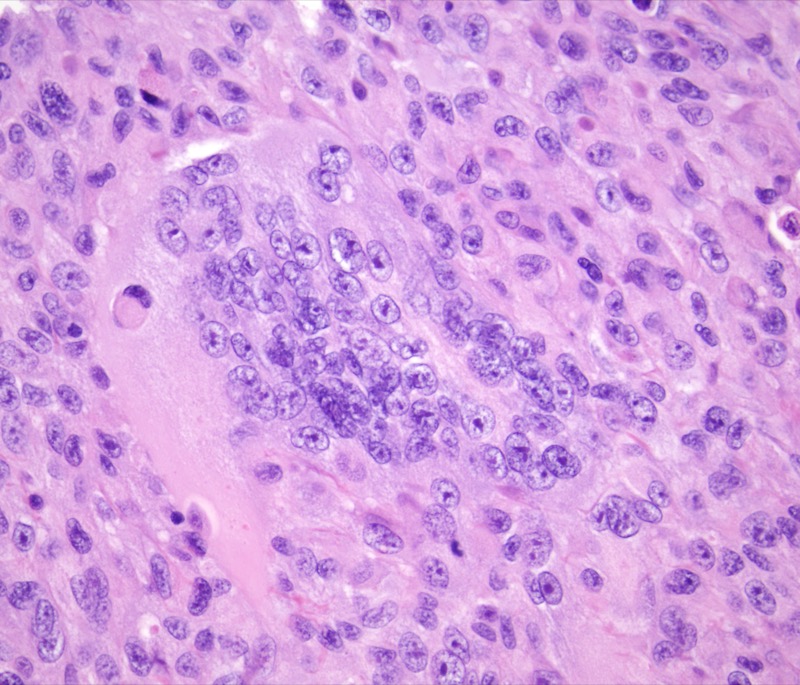 Slide 5: Occasional multinucleated tumor cells contain over 100 nuclei.