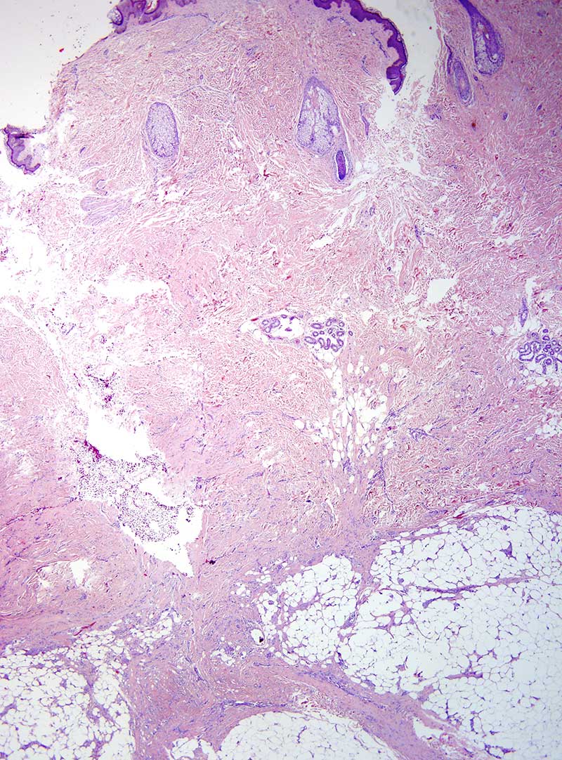 Slide 1: 10 year-old girl with a distal extremity mass.  Within the deeper dermis and subcutaneous fat there is a proliferation that extensively involves the intralobular septa as well as the fat lobule.