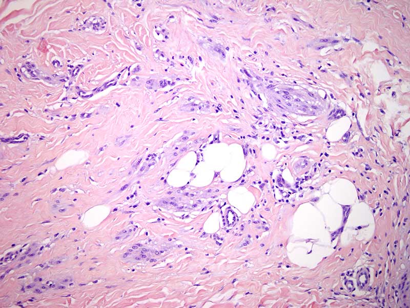 Slide 4: The fascicles and nodules of neoplastic cells are invested with hyalinized collagen bundles.  The dominant cell populace is, in fact, mononuclear.