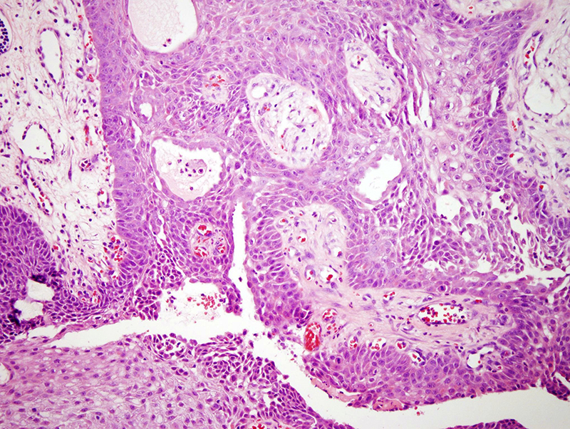 Slide 3: The lesion exhibits an interanastomosing growth pattern with eccrine ductular differentiation.