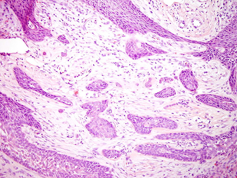 Slide 5: Focally the proliferation assumes an irregular pattern of growth within the dermis.