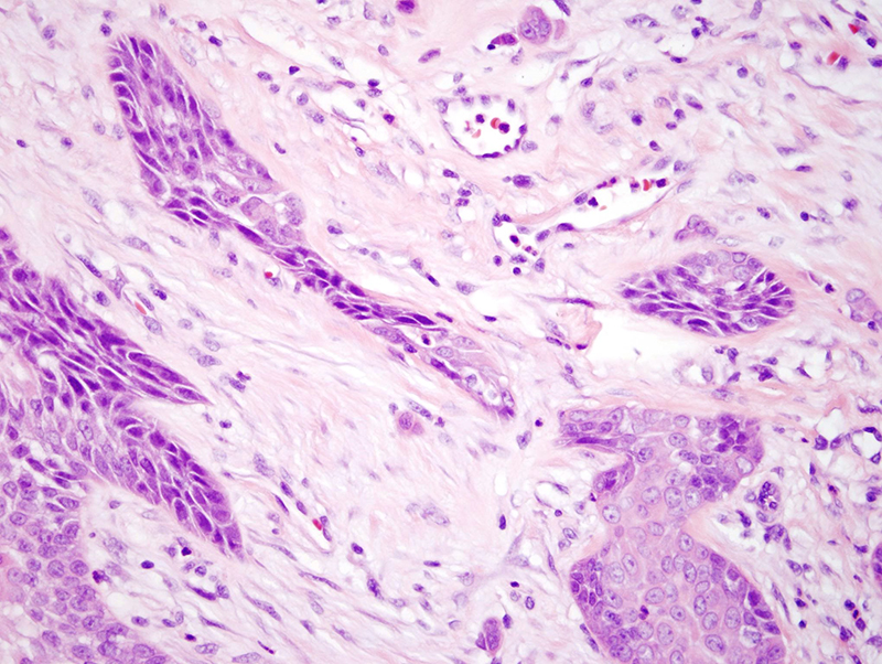 Slide 6: Individual cells and small clusters of severely atypical cells are noted amidst an edematous hypervascular stroma.  Immunohistochemical stains showed focal staining of the tumor cells for cytokeratin-7 and epithelial membrane antigen.  These additional immunohistochemical stains certainly corroborate the diagnosis of a poromatous neoplasm.  Based on the infiltrative growth pattern and epithelial cell atypia I do feel that the lesion is best treated and categorized as a well differentiated porocarcinoma.