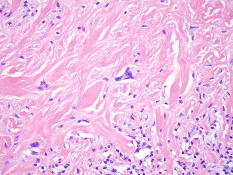 Slide 3: ibroblastic elements particularly accentuated immediately beneath the epidermis where a number of stellate cells with multinucleation and hyperchromasia are noted. There are rare atypical mitotic forms. In the depths of the lesion however the atypia is much less.  Overall it is accentuated in a subepithelial fashion extending in the deeper aspect of the specimen as well although overall the atypia is less away from the epidermal surface.