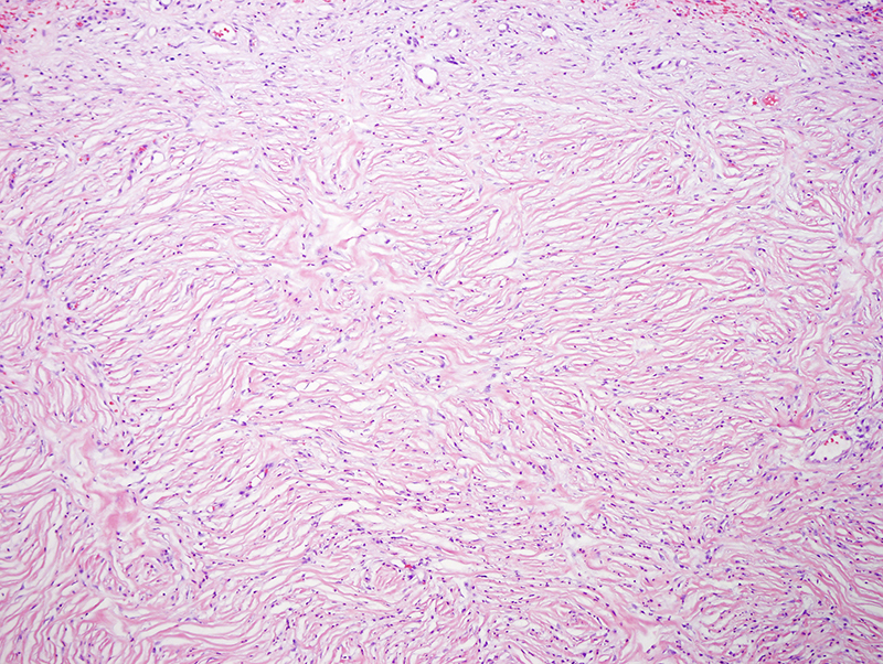 Slide 2: There is a very distinct fibromatous lesion characterized by a whorled pattern of laminated fibroplasia with prominent clefting.