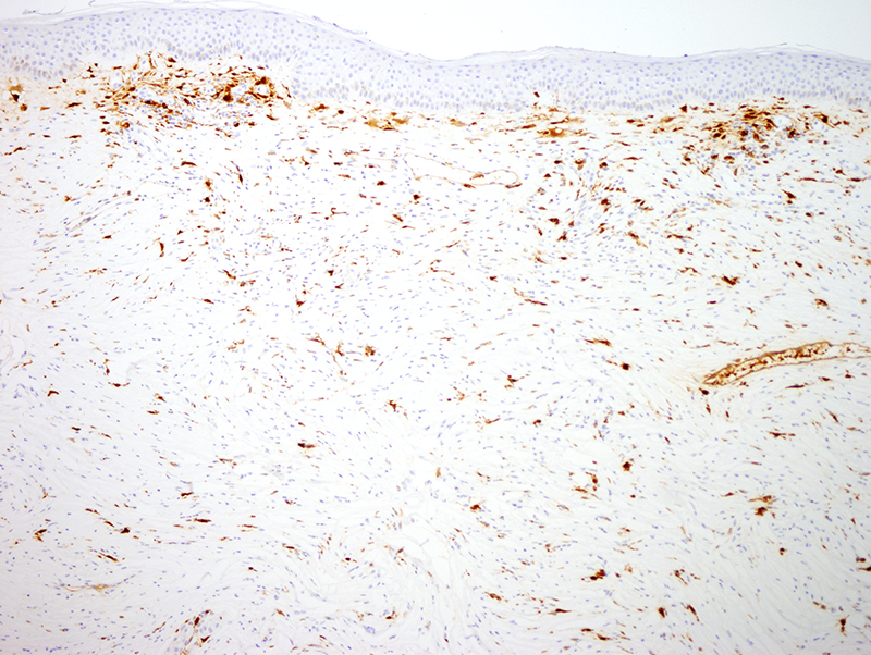 Slide 6: A few dendritic cells are highlighted by Factor-XIIIA.  Overall the diagnostic assessment in this case is that of a storiform collagenoma. While there is some focal staining for epithelial membrane antigen, the lack of greater staining along with the extent of staining for CD34 does not support a diagnosis of perineureoma.