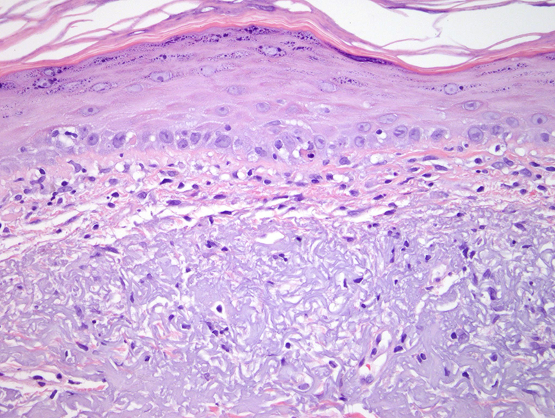 Slide 3: The epidermis is attenuated. An interface dermatitis is noted.