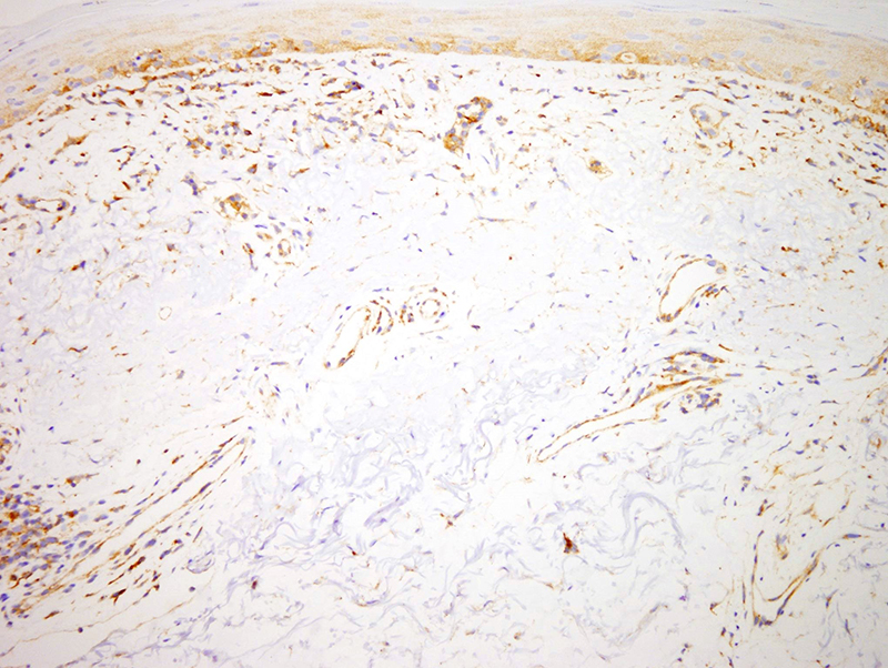 Slide 4: MXA is strongly upregulated; there is extensive staining of the epidermis, microvasculature, and perivascular inflammatory cells.  The findings favor subacute cutaneous lupus erythematosus.