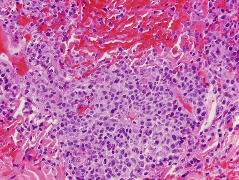 Slide 4: The infiltrate is fairly heterogenous in composition. The dominant infiltrate is comprised of intermediate and larger lymphocytes with occasional mitotic figures. A lymphomatoid vasculitis is present.