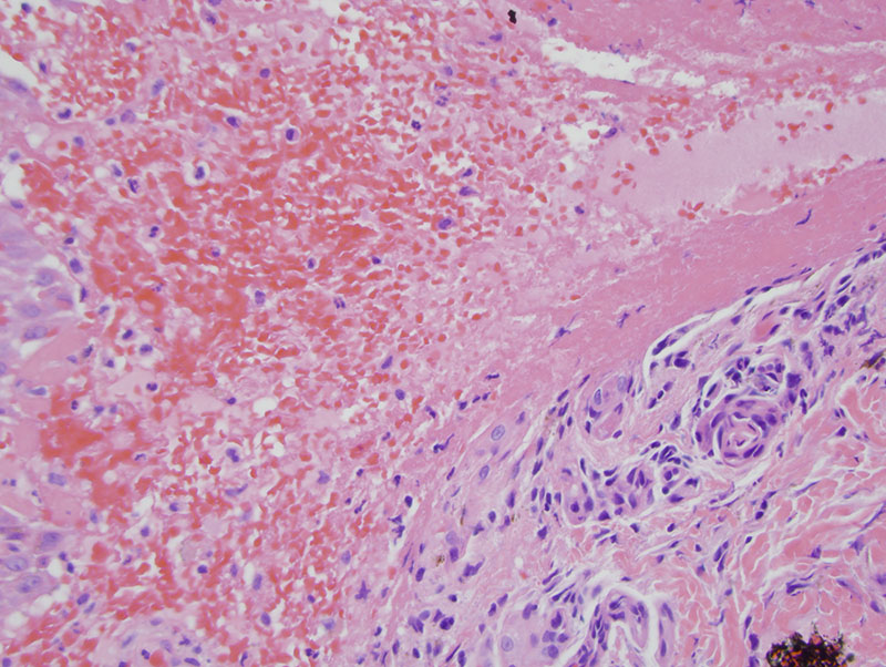 Slide 3: Overall, the process is a hemorrhagic subepidermal bulla with a component of reactive neovascularization. While there are no frank vasculitic changes per se in terms of the lack of luminal mural fibrin deposition, there is, however, leukocytoclasia.