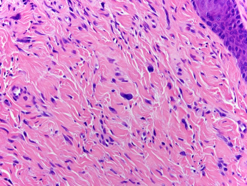 Slide 3: The stellate hyperchromatic cells are somewhat atypical and apparent more superficially.  Overall the lesion is one characterized by a combination of spindled fibroblastic-like cells, stellate triangulated hyperchromatic cells with low grade pleomorphism and abundant collagen.